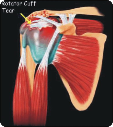 어깨통증의 주범 회전근개부(rotator cuff)의 부상