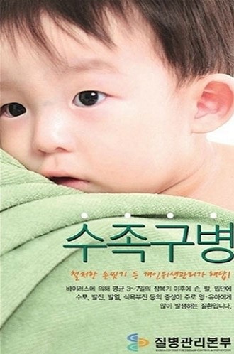 中 영유아 수족구병 극성, 증상과 예방수칙은?