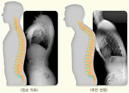 척추후만증