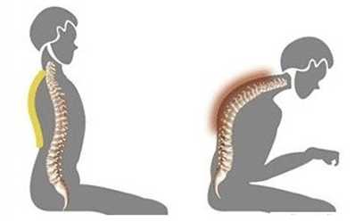 굽은 어깨, 당신의 신체나이 몇 살이세요?