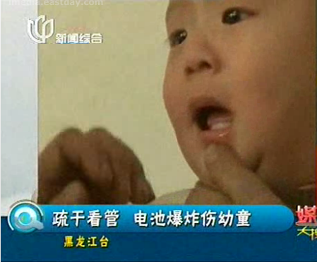 10개월 남아 삼킨 건전지 입안에서 폭발